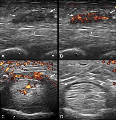 Power Doppler Ultrasound Assessment of A1 Pulley. A New Target of Inflammation in Psoriatic Arthritis?